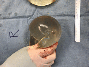 Doctors Claim Woman's Breast Implant Saved Her Life When She Got Shot
